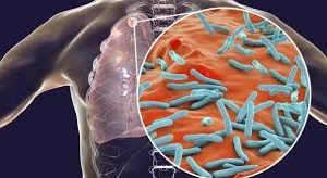 TIBA YA KWELI YA UGONJWA WA KIFUA KIKUU (TB)