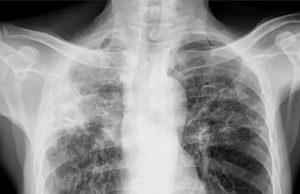 TIBA YA KWELI YA UGONJWA WA KIFUA KIKUU (TB)